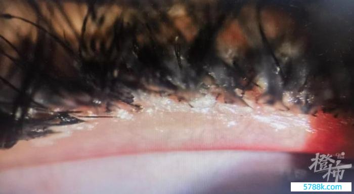 裂隙灯显微镜下像片表露睫毛根部（睑缘）充血、沾满了胶水